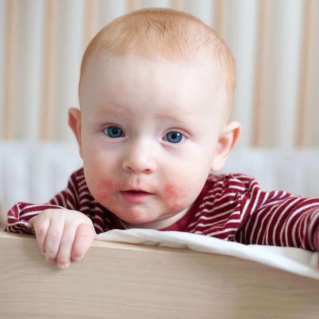 objawy alergii pokarmowej - zaczerwienione policzki z wysypką u niemowlaka